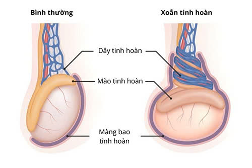 Xoắn tinh hoàn là gì? Xoắn tinh hoàn có tự khỏi hay không?